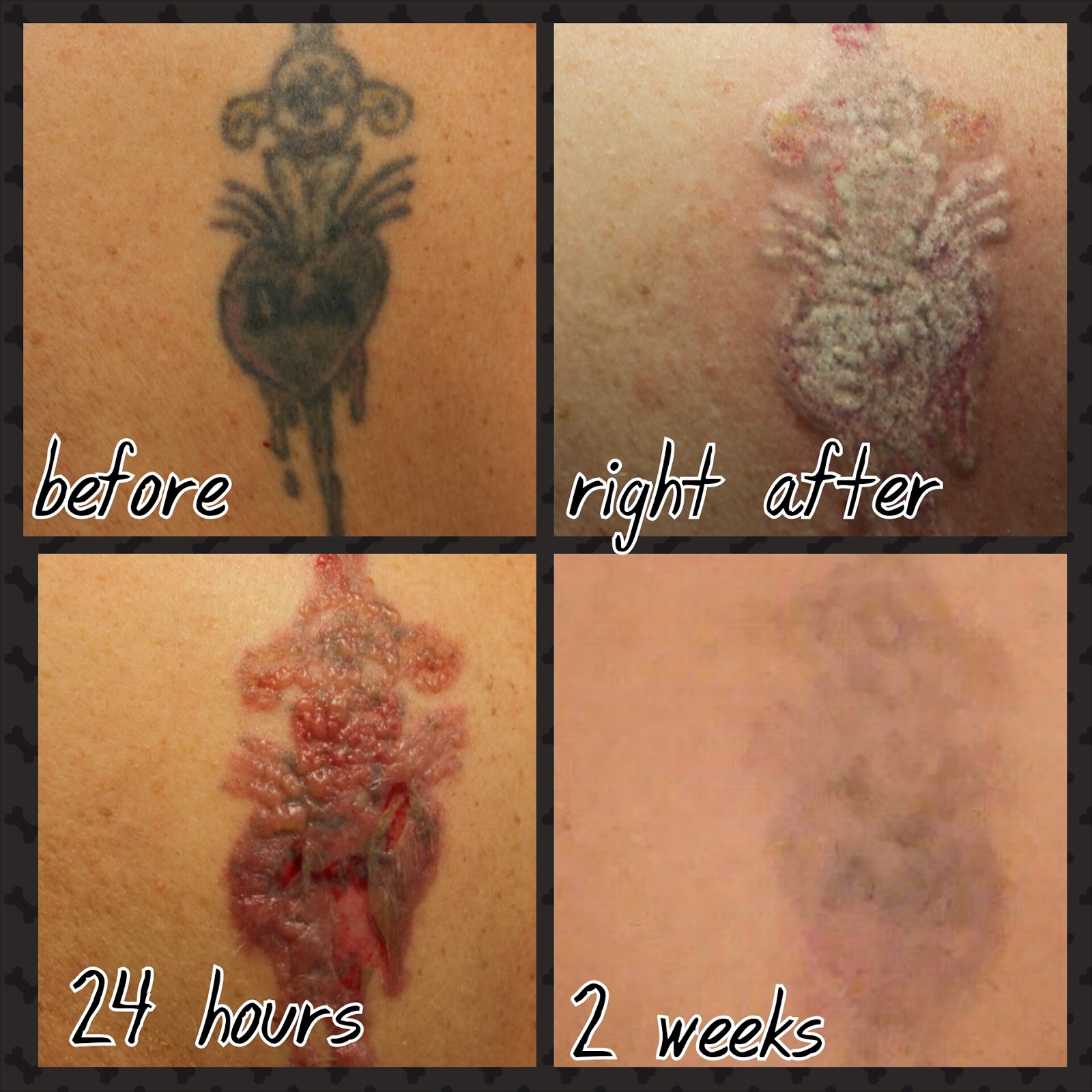 Susan's Orlando Life Picosure Laser Tattoo Removal Review!!!
